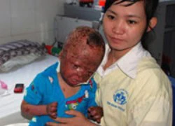 Bé 3 tuổi bị bố hất xăng đốt giờ ra sao?