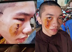 Nhi Nguyen Tinh That Bong Lai demanded compensation of 3 billion for being thrown with bricks in the face: &quot;I went to 4, 5 beauty salons, sad because I have a scar in the middle of my face&quot;