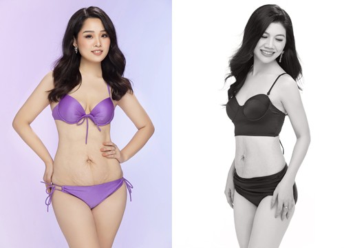 Thí sinh Hoa hậu Doanh nhân mặc bikini để lộ vết rạn da gây tranh cãi