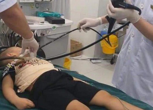 Que nhựa 10 cm mắc trong ruột cả tháng khiến bé trai đau quặn bụng phải nhập viện
