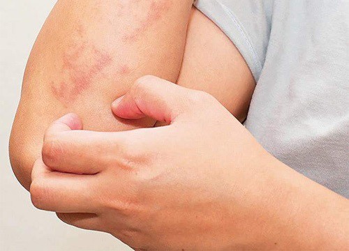 Dấu hiệu trên da cảnh báo nhiều loại ung thư