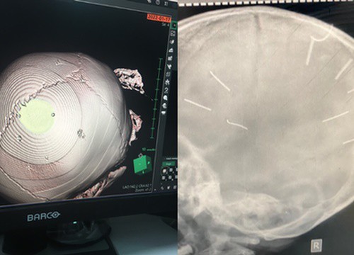 The case of a 3-year-old child with 9 nail-like objects in the skull: Family members speak up, revealing the sad truth?