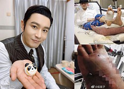 Huynh Xiaoming had an accident and had to &#39;implant screws&#39; on his body