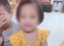 The case of a 3-year-old girl being nailed to the head: Health is improving but still can&#39;t have surgery