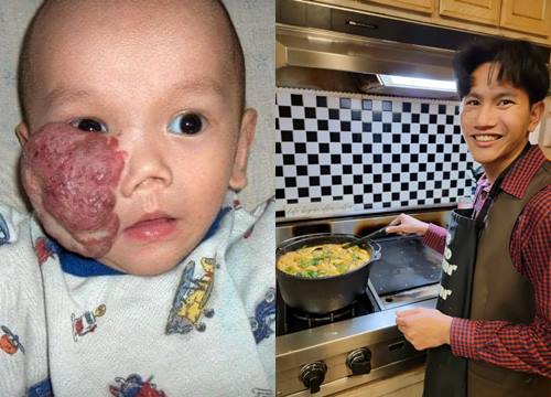 A Vietnamese-born boy with a tumor covering half of his face &quot;molts&quot; after being adopted by American parents