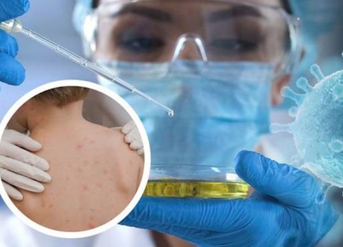 CẢNH BÁO: Virus đậu mùa khỉ có thể đã âm thầm lây lan!