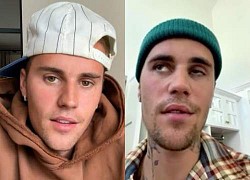 Justin Bieber has half-face paralysis, an expert speaks out about the male singer&#39;s condition