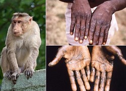 Monkey pox and things to pay special attention to