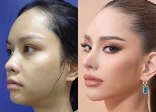 Hình ảnh 'dao kéo' của Hoa hậu Hoàn vũ Thái Lan làm bùng nổ tranh cãi