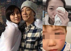 Former love Tran Tieu Xuan - Xa Uyen was &#39;physically affected&#39; by her husband and had to be bandaged all over 