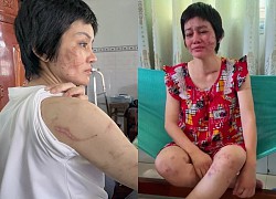 The case of a 7 month pregnant woman being &quot;violently&quot; by her husband using hot zinc to her face: The husband spoke up