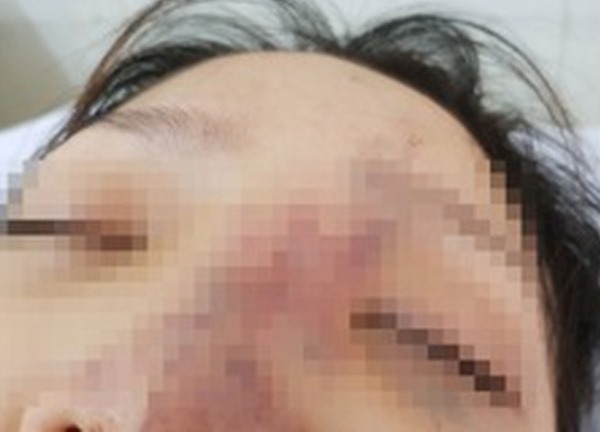 Lại tai biến nghiêm trọng khi tiêm filler ở thẩm mỹ 'chui'