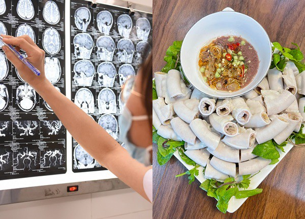 Sau bữa ăn lòng lợn, người phụ nữ viêm màng não nguy kịch, phải nhập viện thở oxy liều cao