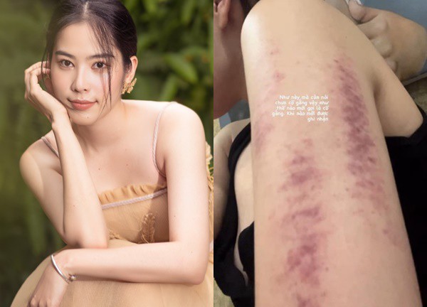 Nam Em gây lo lắng với thân hình bầm dập, nhiều vết bầm tím trên cơ thể, nói lời than trách, bất lực