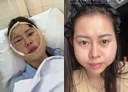 Viet Phuong Thoa's face was deformed because the filler injection was switched to silicon, and had to have urgent surgery