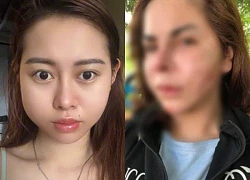 Hiểm họa khó lường khi tiêm silicon lỏng làm đẹp, Việt Phương Thoa "tởn" đến già
