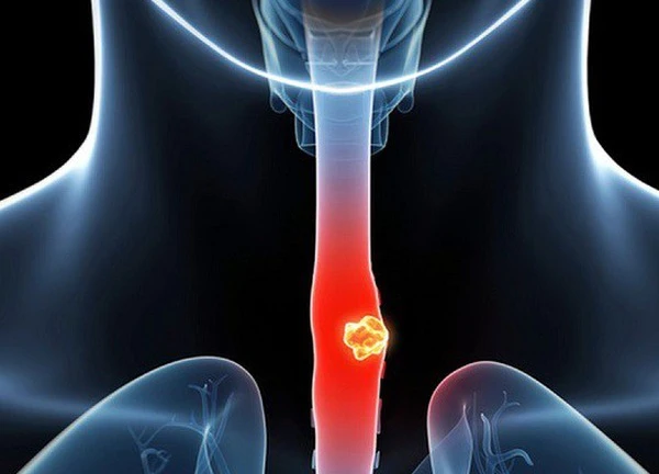 6 câu hỏi thường gặp về ung thư thực quản
