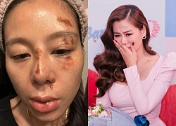 Photos of Nam Thu appearing with a face full of injuries after the drama "ba ba"