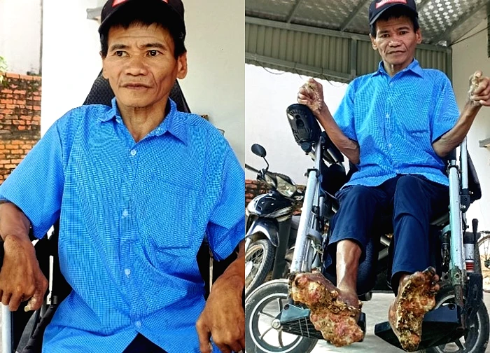 Cuộc sống của người đàn ông mắc bệnh 'người cây' hiếm gặp ở Ninh Bình