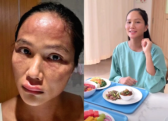 H'Hen Nie has a strange disease after giving birth that only 1 in 10 people get, spending half a billion on confinement