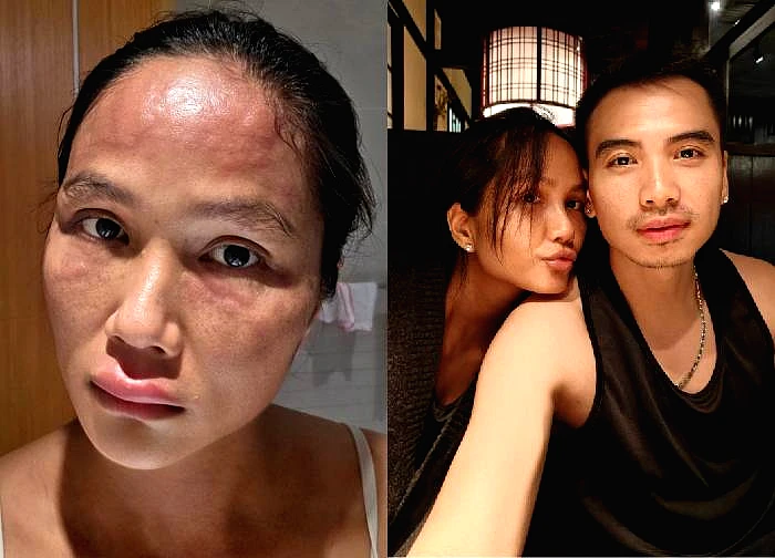 H'Hen Nie fights rare disease after giving birth, cures it with strange method