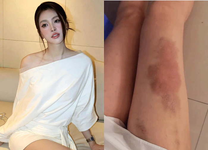 Tieu Vy revealed a strange red spot on her legs, rumored to be due to improper beauty?