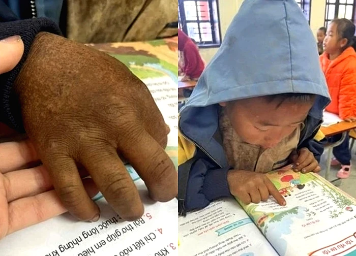 Bàn tay nứt nẻ của cậu bé 8 tuổi vùng cao khiến triệu người nghẹn lại
