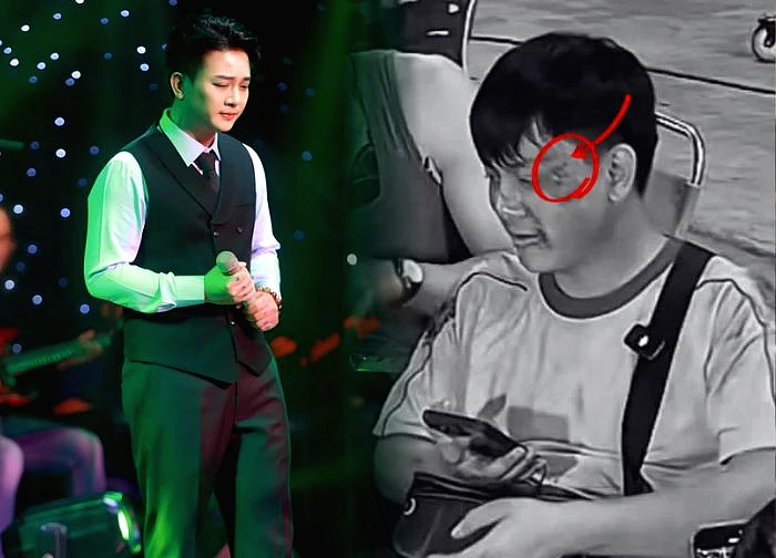 Hoài Lâm's bruised face and tired appearance have caused concern among netizens, but what's the truth?