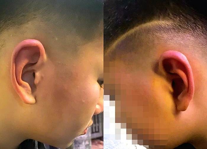 Bé trai ở Hà Nội nghi bị bố của bạn tát, đánh vào đầu