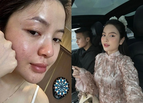 Quang Hai's wife shows her face full of acne, her husband makes an even more shocking statement