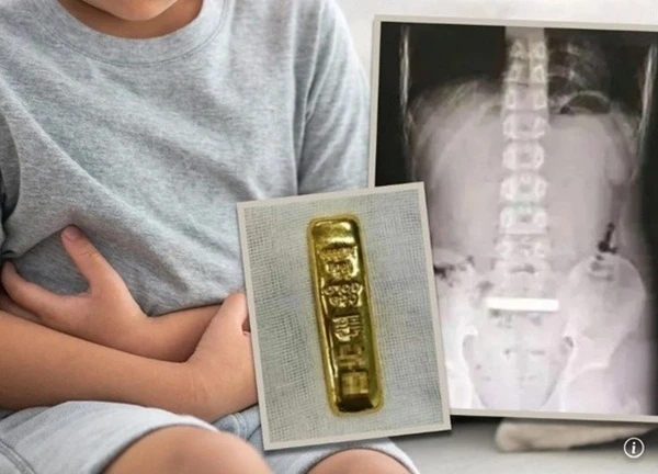 Cậu bé 11 tuổi nuốt thỏi vàng gần 3 lượng