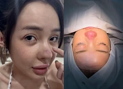 Ngân 98 công khai ảnh biến chứng mũi kinh hoàng! CĐM nhìn mà "lạnh sống lưng"