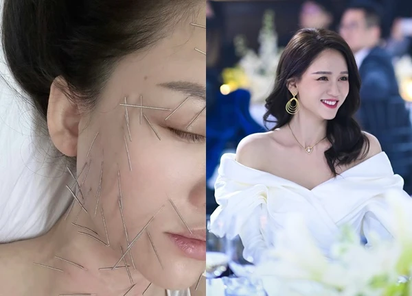 Sốc nặng hình ảnh Trần Kiều Ân cắm hàng trăm chiếc kim khắp cơ thể, làm đẹp mà chấp nhận đau đớn không tưởng!