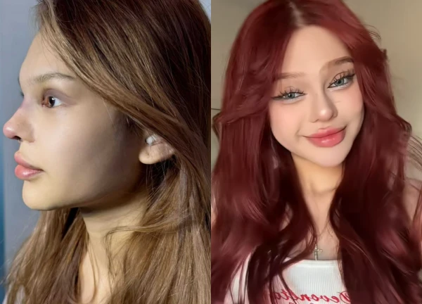 Hot TikToker "got plastic surgery" before 18, just got under the knife for the nth time, netizens shake their heads