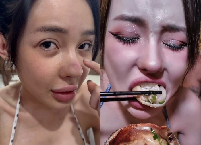 DJ Ngân 98 thản nhiên ăn hải sản khi mũi đang bị biến chứng nhiễm trùng nặng?