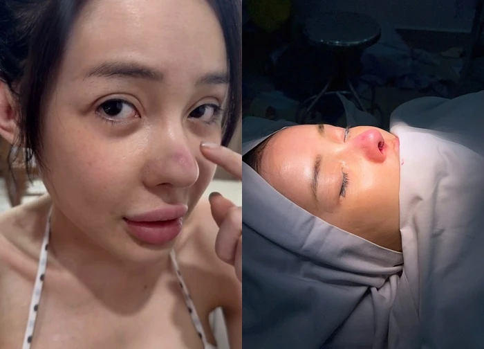 Ngân 98 bị biến chứng nhiễm trùng nặng sau 11 lần phẫu thuật thẩm mỹ
