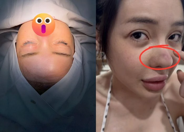 Ngan 98 revealed a red bump on her nose, canceled 2 shows in Cambodia, doctor gave a shocking diagnosis