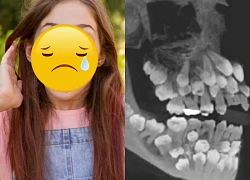 Rare girl has 81 teeth, exceeding the normal limit, doctors "give up"?