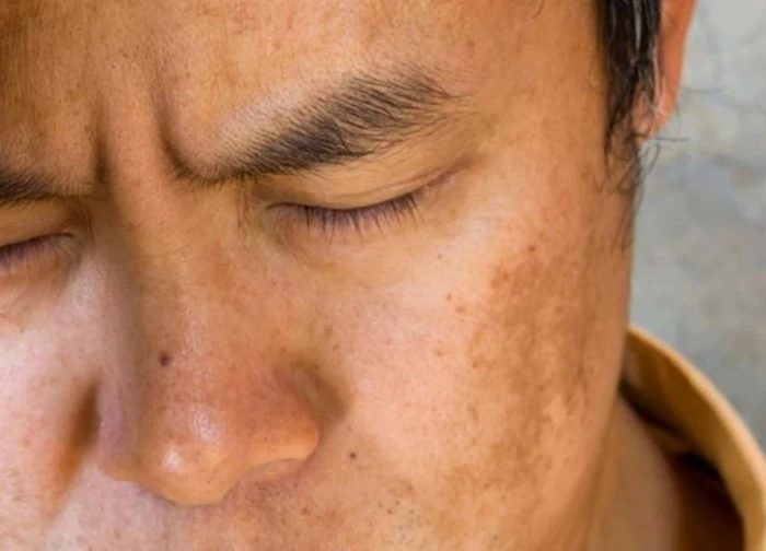 Vàng da sinh lý và vàng da bệnh lý khác nhau thế nào?