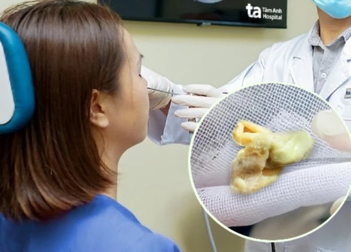 Thở thấy mùi hôi, người phụ nữ 31 tuổi ở TP.HCM phát hiện bị thẩm mỹ viện bỏ quên một thứ trong mũi suốt 1 tháng