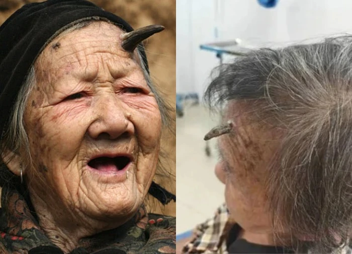 A 100-year-old woman grew a long 'horn' on her forehead and cut it off herself. She is in critical condition. What strange disease does she have?