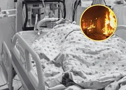 Father burned son in TN: son's burn area is larger than mother's, revealing a series of shocking points