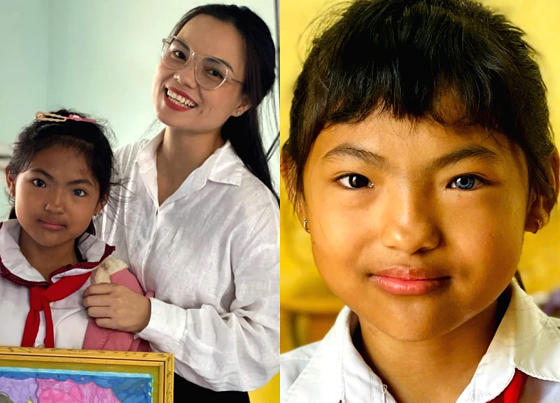Cô bé có đôi mắt "âm dương" kỳ lạ ở Tây Nguyên