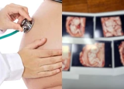 Sản phụ 24 tuổi gây sốc khi sinh 5 tự nhiên, tỷ lệ 1/60 triệu, 20 bác sĩ vây quanh