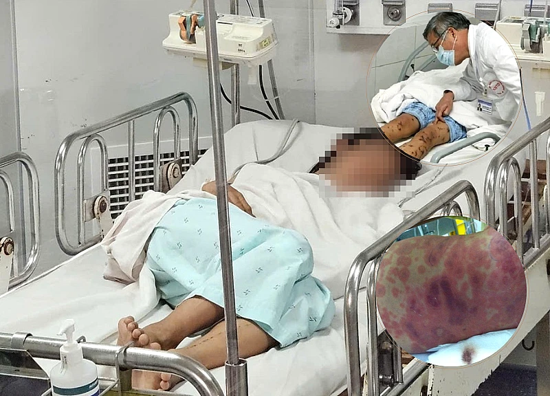 Ho Chi Minh City sees more cases of meningococcal meningitis, which is spreading rapidly and could have severe consequences?